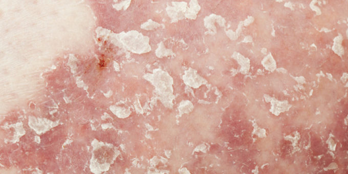 PSORIASIS
