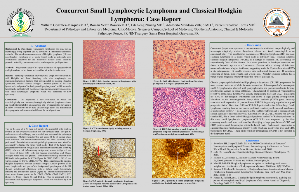 Concurrent Small Lymphocytic Lymphoma and Classical Hodgkin Lymphoma - Case Report