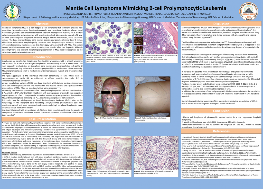 Mantle Cell Lymphoma Mimicking B-cell Prolymphocytic Leukemia