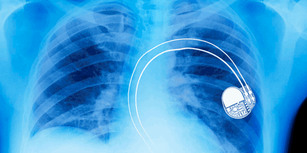 FDA Recalls Nearly Half A Million Pacemakers Over Hacking Fears ...